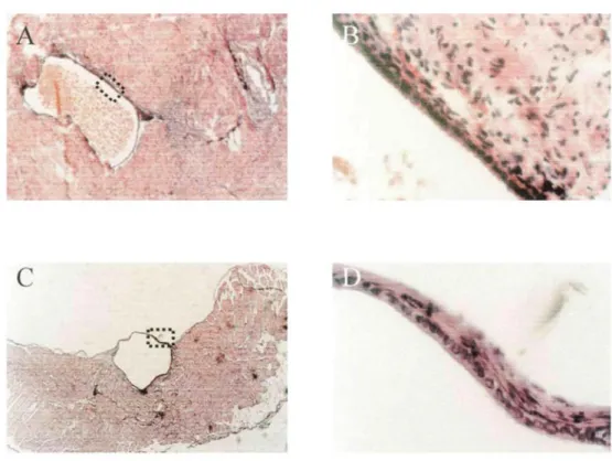 Figure 2: Comparison between endometriotic cyst stained with hematoxylin-eosin in woman with peritoneal  lesion of endometriosis (A, x50; B, x400) and endometrial-like structures detected in nude mice injected with  mixed populations of human stromal and e