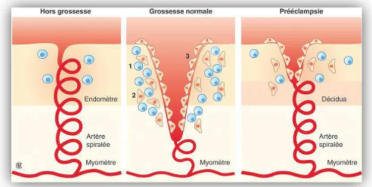 Figure 1 : Modifications des artères utérines pendant la  grossesse normale et en cas de pré-éclampsie 