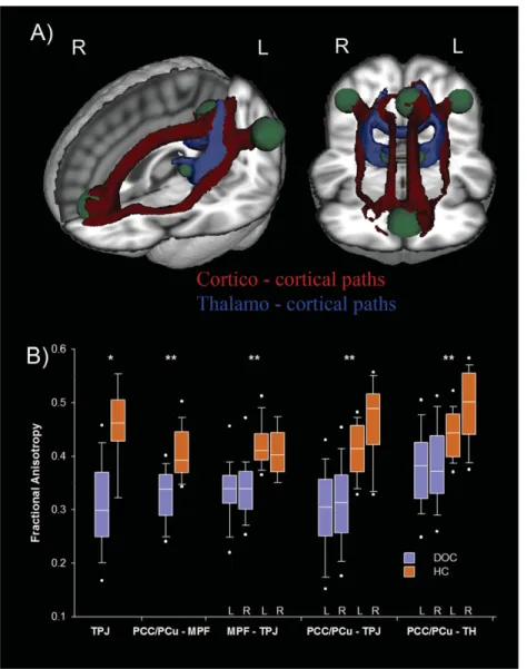 FIGURE 2: (A) Three-dimensional representation of the corticocortical (in red) and thalamocortical (in blue) paths showing reduced fractional anisotropy values in the patients relative to healthy participants