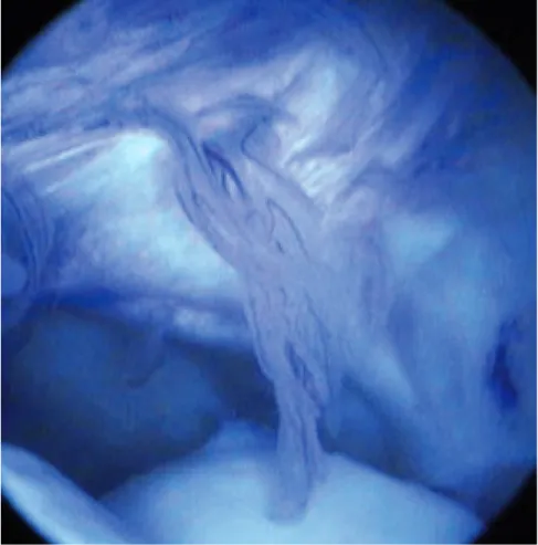 Figure  1 :  Franges  synoviales  hyperémiques  et  épaissies,  signes  typiques  d’une  synovite,  vues  par  arthroscopie.