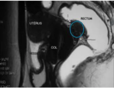 Figure 3 : IRM pelvienne ; coupe sagittale d’un nodule d’endométriose profonde rectale 