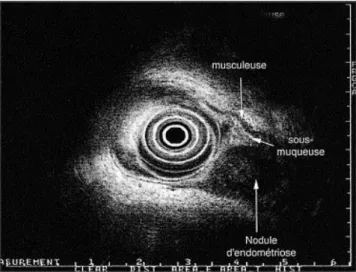 Figure 4 : Écho-endoscopie rectale ; nodule sténosant la lumière rectale 