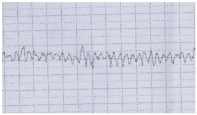 Figure 4 : Rythme cardiaque fœtal sinusoïdal 