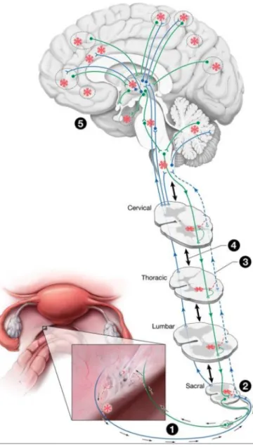 Figure  1 :  Cette  figure  illustre  comment  les  lésions  endométriales  peuvent  engager  le  système  nerveux  pour  donner  lieu  à  différents  types  de  douleur