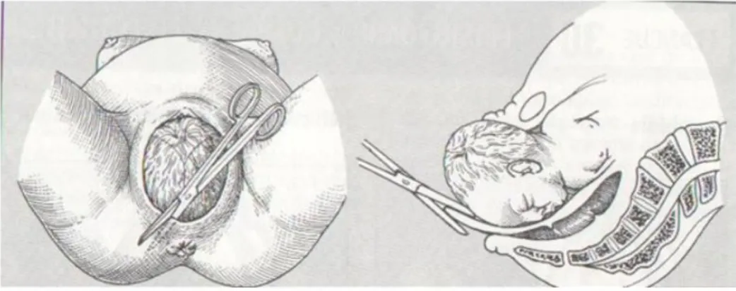 Figure 2 : Technique de l’épisiotomie médio-latérale 