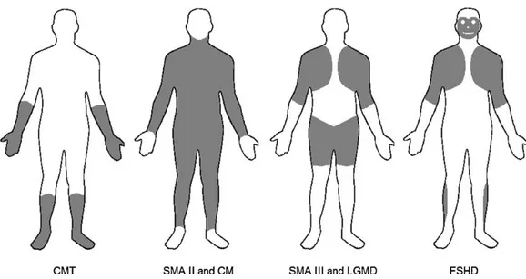 Figure 1 : Atteintes musculaires des différentes maladies neuromusculaires (zones grises) (3) 