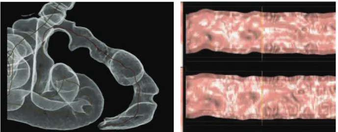 Fig 9 : reconstruction 3D double contraste                                           Fig 10 : reconstruction 3D autodissection 