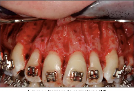 Figure 5 : Incisions de corticotomie (10)