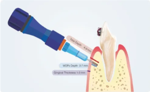 Figure 11 : MOPs lors de la rétraction canine (9) Figure  10  :  Schéma  montrant  l’utilisant  du tournevis : le Propel®  (9)