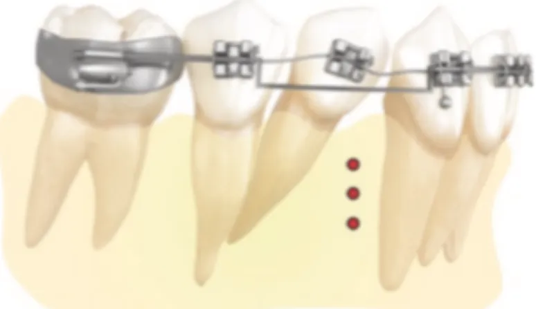 Figure  15  :  Schéma  montrant  utilisation  des MOPs pour redresser une dent (9)