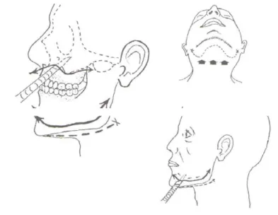 Figure 2 : les traits d’incision de la technique Keiser-Nielsen (16) 
