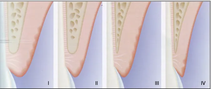 Figure  7: Les 4 types de parodonte selon Maynard et Wilson (1980)(30) 