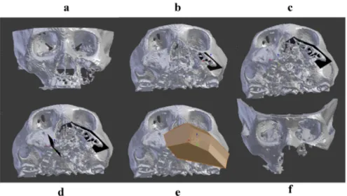 Figure 7 : Planification de la résection maxillaire. (a) L’anatomie faciale initiale. (b) le premier plan de coupe est réalisé  dans la lésion zygomatique