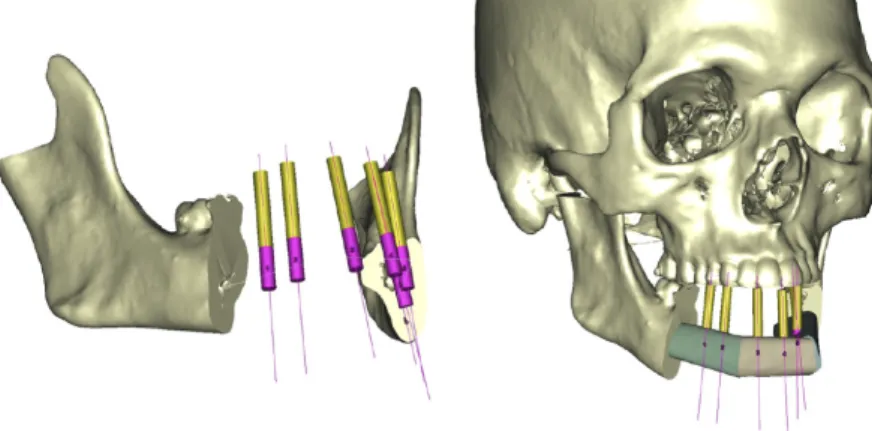 Figure 9 : Planification de la reconstruction à partir du positionnement des implants en fonction de l’arcade dentaire  antagoniste (18)