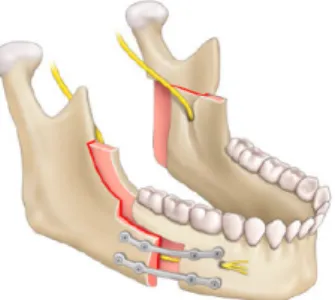 Figure   22   :   Ostéotomie   sagittale   des   branches   montantes,   d’après   EMC(28)           