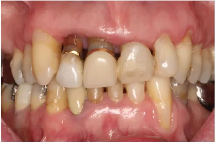 Figure 2 : parodontite (service de parodontologie de Strasbourg) 