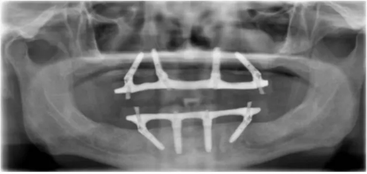 Figure 12 : Panoramique d’un patient avec une réhabilitation des maxillaires avec le concept All-on- All-on-four (Malo 2012 (18)) 