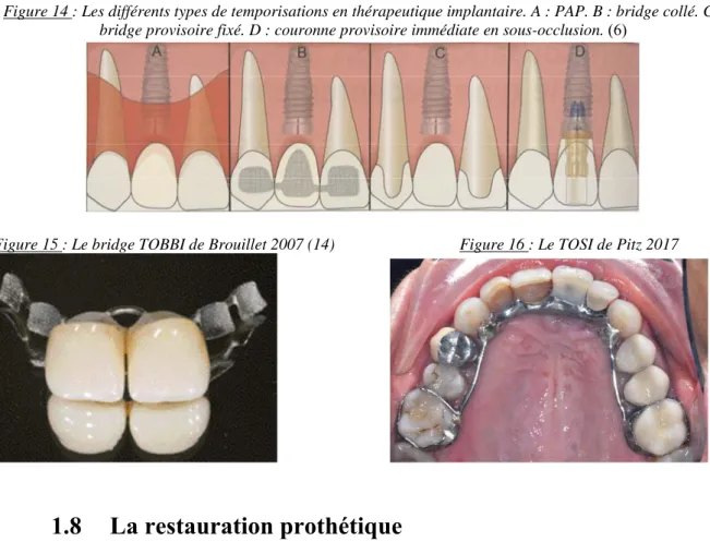 Figure 14 : Les différents types de temporisations en thérapeutique implantaire. A : PAP