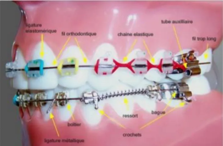 Figure 2 : Illustration de plusieurs dispositifs utilisés en orthodontie fixe 