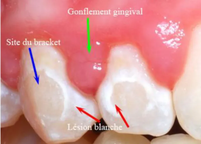Figure 3 : Lésions amélaires initiales post-orthodontique  