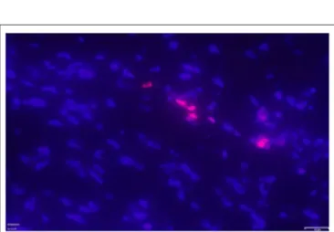 FIGURE 8 | Exemplary positive TUNEL staining (pink fluorescent staining) in the right atrial myocardium of one patient with ASD