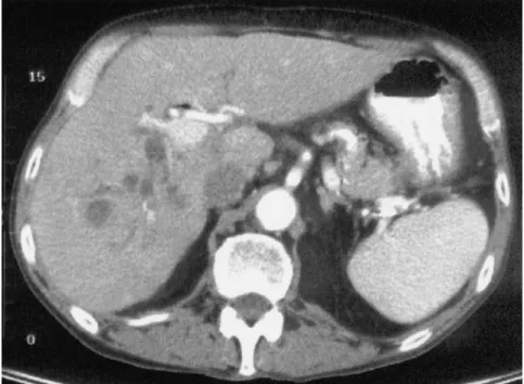 Figure 3. Endoscopic retrograde cholangiography of pa- pa-tient 3 showing strictures mainly localized in the right intrahepatic bile ducts.