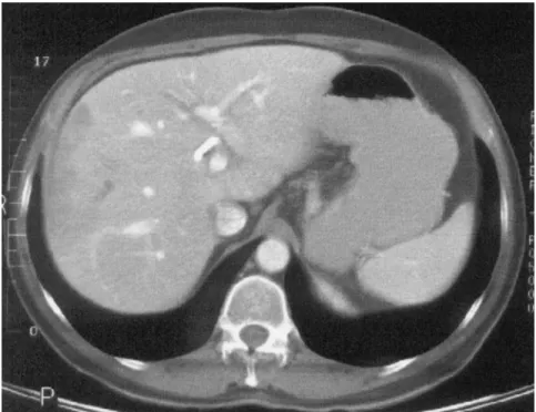 Figure 5. Abdominal CT of patient 3 showing compensatory hypertrophy of the left liver graft lobe 6 months after RHL.