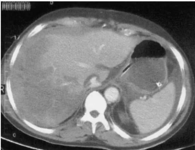 Figure 6. Abdominal CT of patient 4 showing ischemic necrosis of the right liver graft lobe 48 hours after LT.