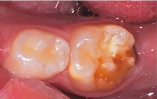 Figure 2 : Situation clinique d’une 75 hypominéralisée présentant une fracture de l’émail post-éruptive  laissant apparaître une dentine à nu (courtoisie du Dr E