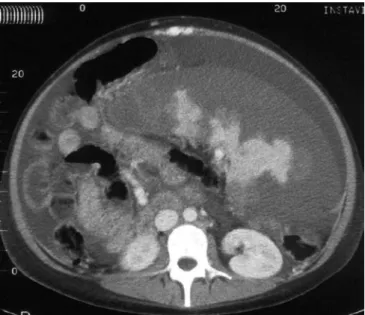 Fig. 1 Abdominal computed tomodensitometry showing 80% spleen embolization of the enlarged spleen and ascites