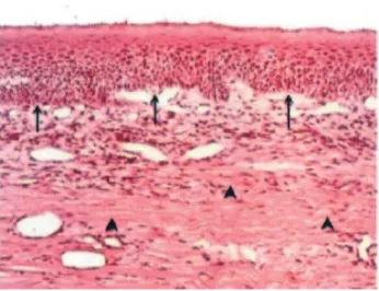 Figure 5: Fin distraction : atrophie gingivale avec  diminution épaisseur couche épithéliale, perte  papilles conjonctives et des digitations 