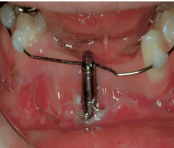 Figure 12: arc ODF pour correction du vecteur de distraction (40). 