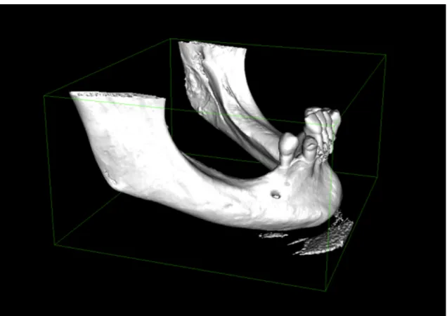 Figure   7:   Rendu   3D   surfacique   avant   export   sous   Osirix®   