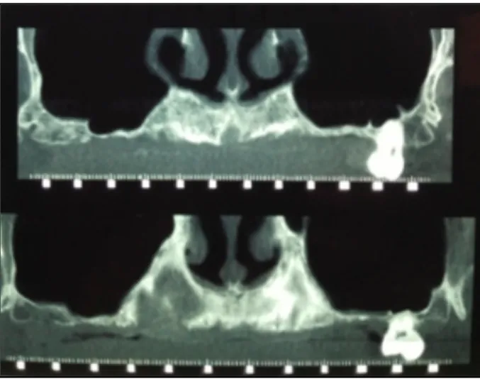 Figure 6 : Coupes coronales pré-opératoires montrant les défauts osseux verticaux. Courtoisie Dr Baldy