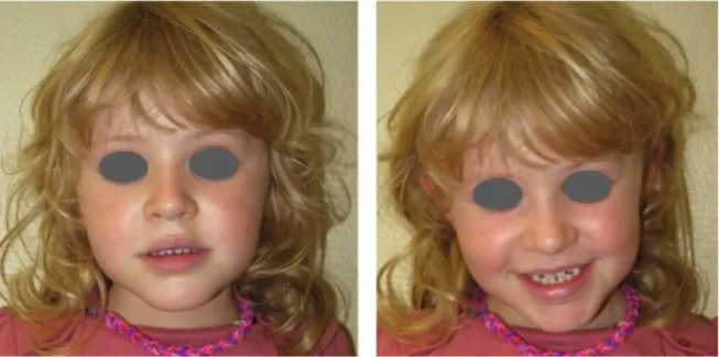 Figure 2: Photographies exobuccales de face d'une jeune patiente en classe III 