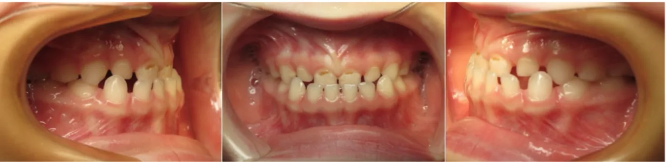 Figure 4: Occlusion statique de type classe III: mésioposition de la canine mandibulaire et  occlusion antérieure inversée 