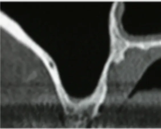 Figure 2 : Visualisation de l'artère alvéolo-antrale au scanner pré-opératoire (Dr. 