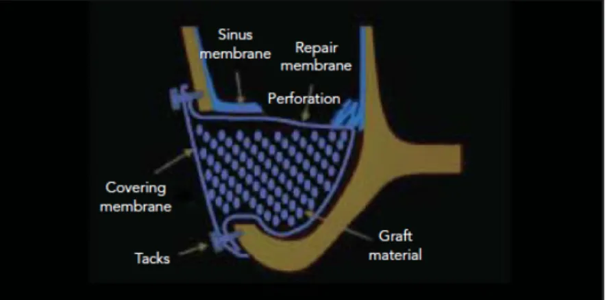 Figure 5: gestion d'une perforation de la membrane sinusienne sans interruption de la  chirurgie