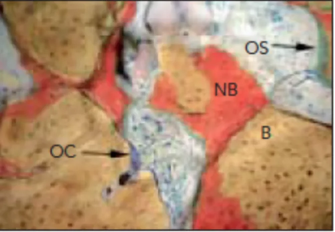 Figure 12: coupe de greffe avec le Bio-oss® (B) NB = nouvel os formé, OS en vert =  tissu ostéoïde, OC = cellule géantes mutinuclées 
