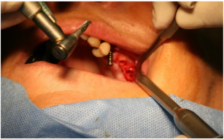 Figure 14 : Forages successifs du deuxième et troisième implant. 