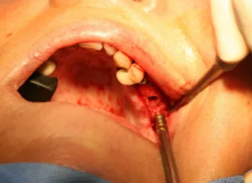 Figure 16 : Levée du sinus par voie crestale à l’aide d’un ostéotome. 