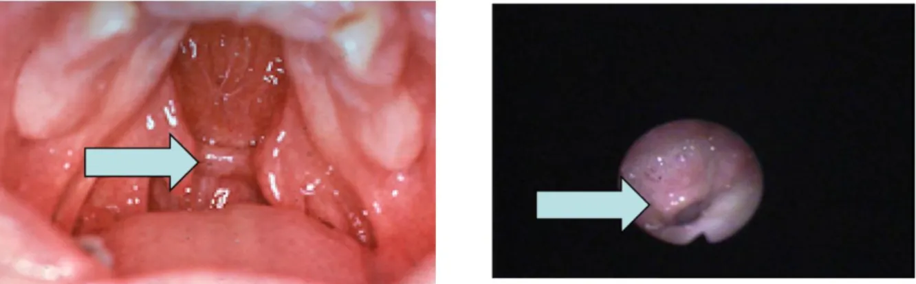 Figure 24 (4) : Bourrelet de Passavant visible à l’examen clinique et en nasofibroscopie   