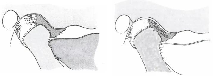 Figure 8. Schéma d’une ATM saine versus schéma d’une ATM arthrosique. D’après Dawson. (17, 18) 