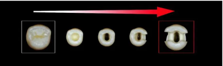 Figure n°1 : Risque de fracture d’une dent dépulpée par rapport à la perte tissulaire,  d’après Rocca et coll