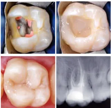 Figure n°6 : Réalisation d’une restauration partielle collée directe en résine  composite avec la technique dite « sandwich-fermé » (34)