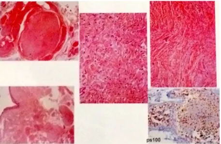 Figure 3. Résultat de l'observation par microscopie optique de la pièce opératoire prélevée au niveau de la  tumeur orbitaire du patient le 12 juin 2009 par le Dr LONGUEVILLE