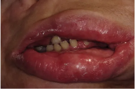 Figure 4. Inocclusion labiale, macrochéilite et affaissement des tissus mous péri-oraux  