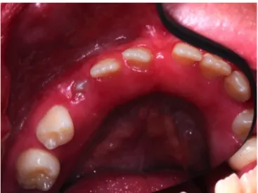 Figure 7. Gencive hyperplasique et malpositions des dents 41 et 42  Crédit photo : Dr Patrick ROUAS 
