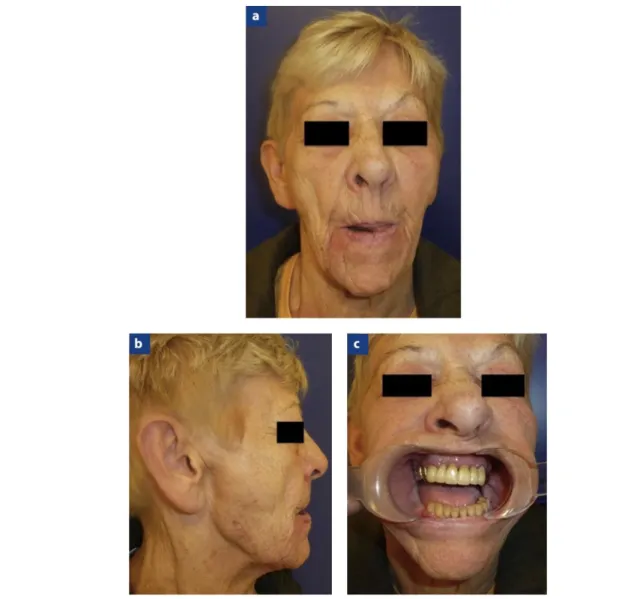 Figure 10 : Patiente présentant une luxation antérieure bilatérale des articulations temporo-mandibulaires :   a et b : Allongement de la face, inocclusion labiale et dépression prétragienne, c : Béance dentaire totale