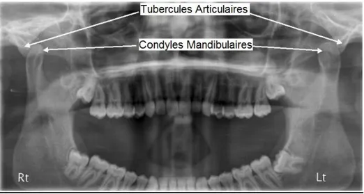 Figure 13 : Radiographie panoramique présentant une luxation condylienne antérieure bilatérale 